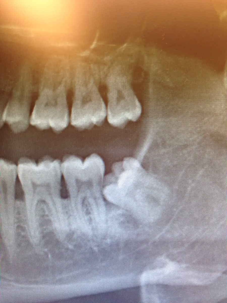 Dental X-ray of a jaw, with a wisdom tooth lying sideways under the others